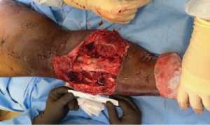 Dr. Moon Cedars Case #2 - Surgery performed - leg fracture
